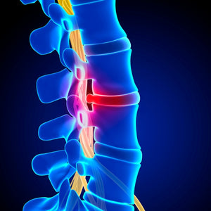 Disc Injury
